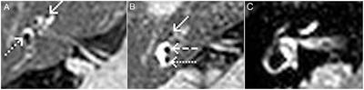 The Additional Value of Endolymphatic Hydrops Imaging With Intratympanic Contrast for Diagnostic Work-Up—Experience From a Neurotology Center in Austria